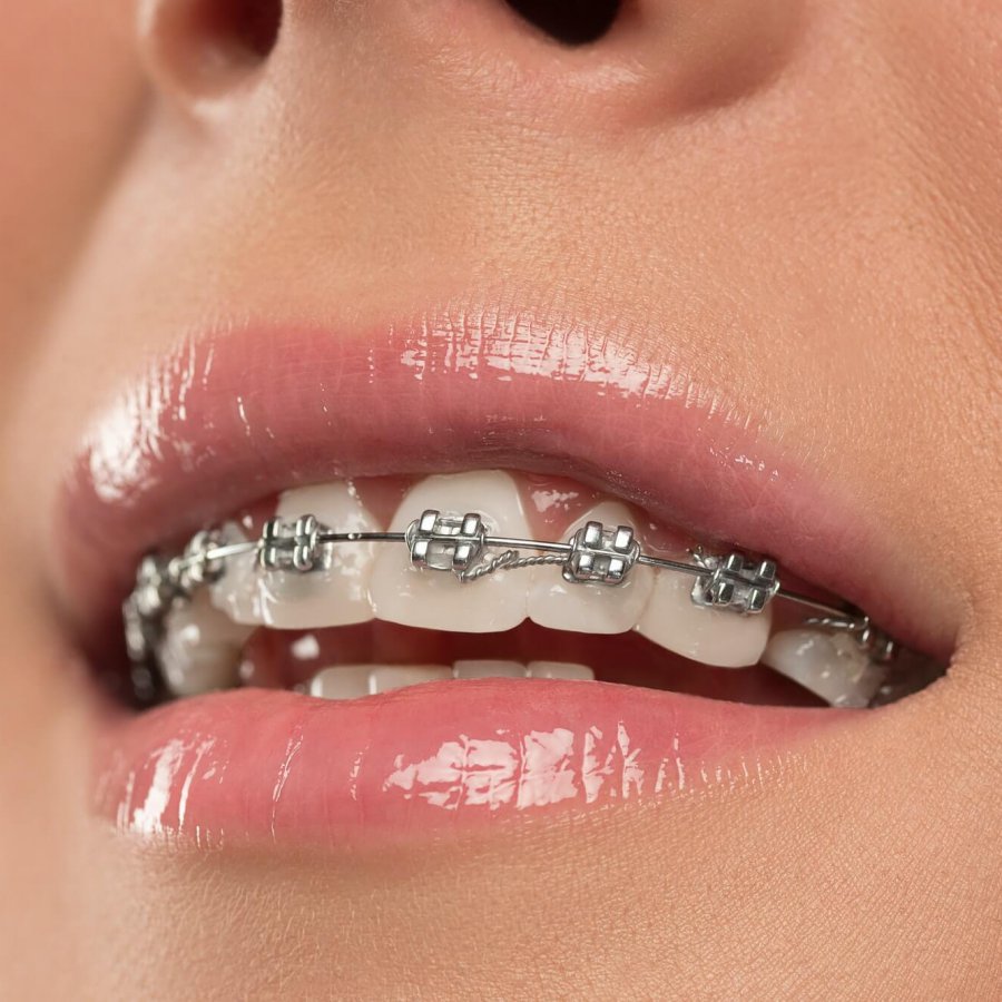 Beautiful young woman with teeth braces