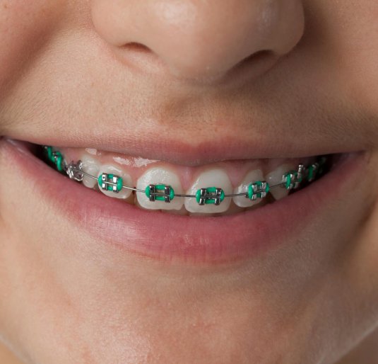 Close up of dental braces in the mouth of a teenage girl